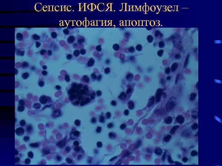 Сепсис. ИФСЯ. Лимфоузел – аутофагия, апоптоз. 