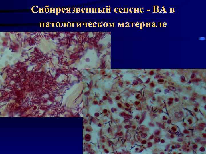 Сибиреязвенный сепсис - ВА в патологическом материале 