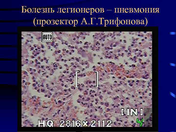 Болезнь легионеров – пневмония (прозектор А. Г. Трифонова) 