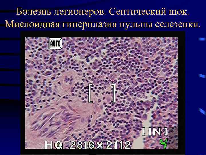 Болезнь легионеров. Септический шок. Миелоидная гиперплазия пульпы селезенки. 