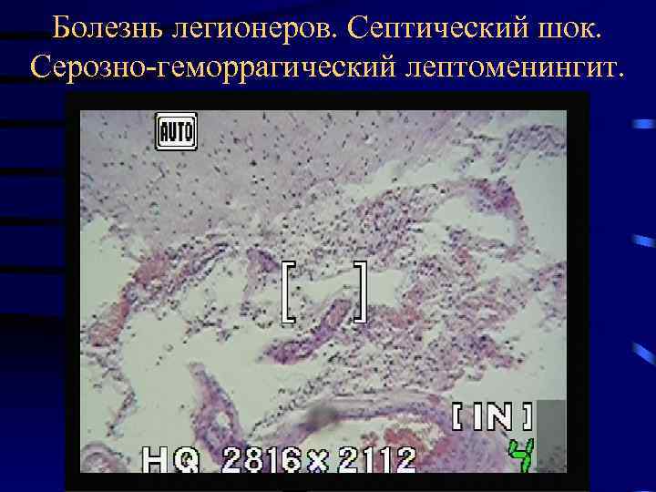 Болезнь легионеров. Септический шок. Серозно-геморрагический лептоменингит. 
