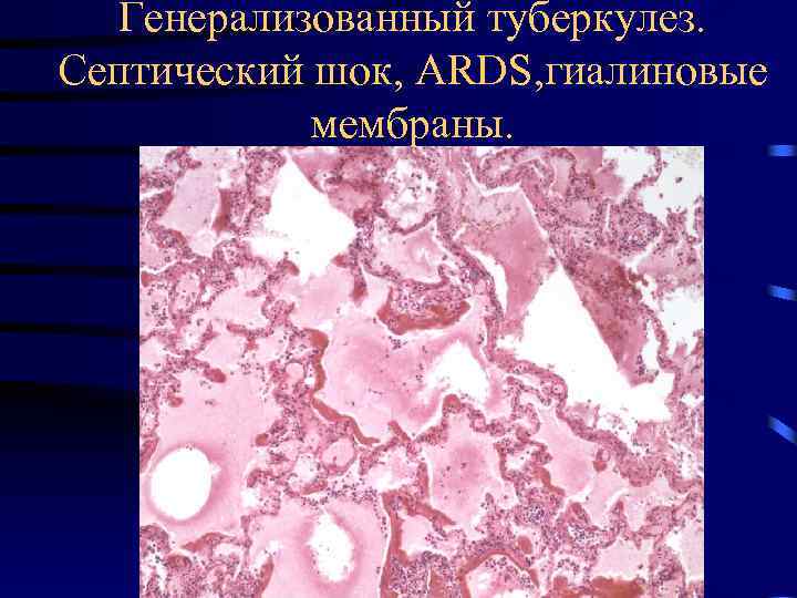 Генерализованный туберкулез. Септический шок, ARDS, гиалиновые мембраны. 