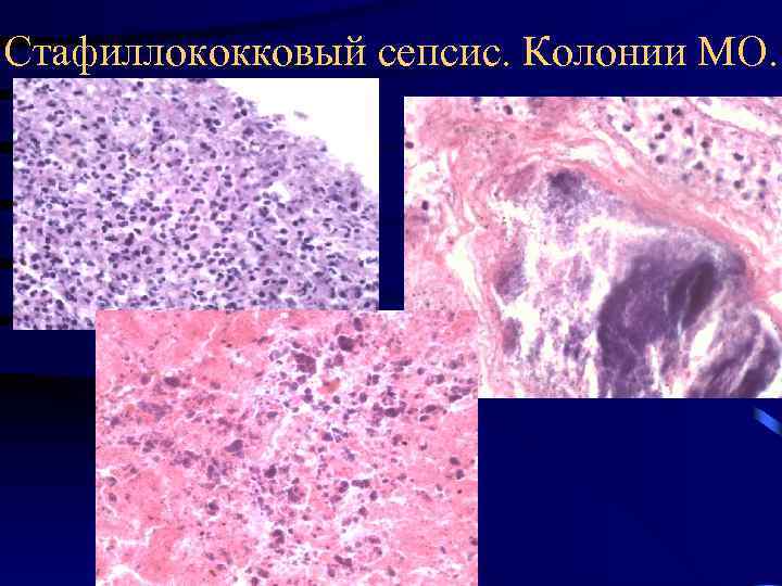 Стафиллококковый сепсис. Колонии МО. 
