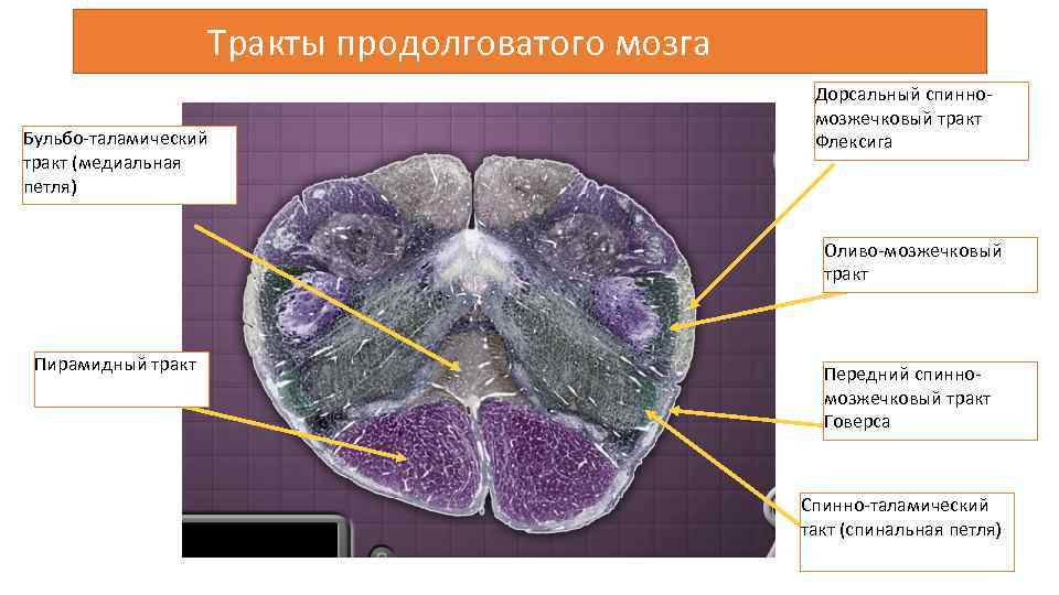 Тракты продолговатого мозга Бульбо-таламический тракт (медиальная петля) Дорсальный спинномозжечковый тракт Флексига Оливо-мозжечковый тракт Пирамидный