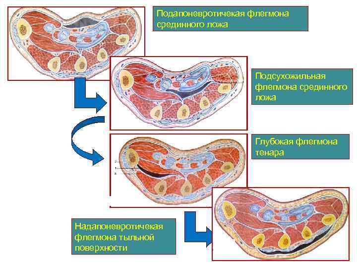 Подапоневротичекая флегмона срединного ложа Подсухожильная флегмона срединного ложа Глубокая флегмона тенара Надапоневротичекая флегмона тыльной