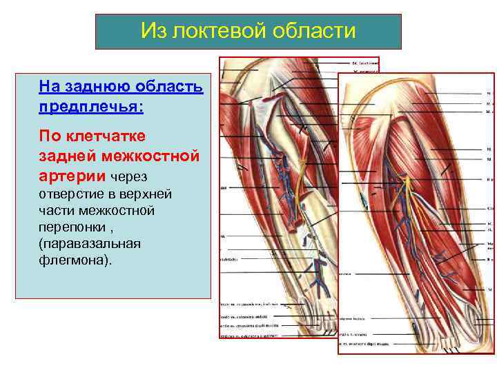 Из локтевой области На заднюю область предплечья: По клетчатке задней межкостной артерии через отверстие