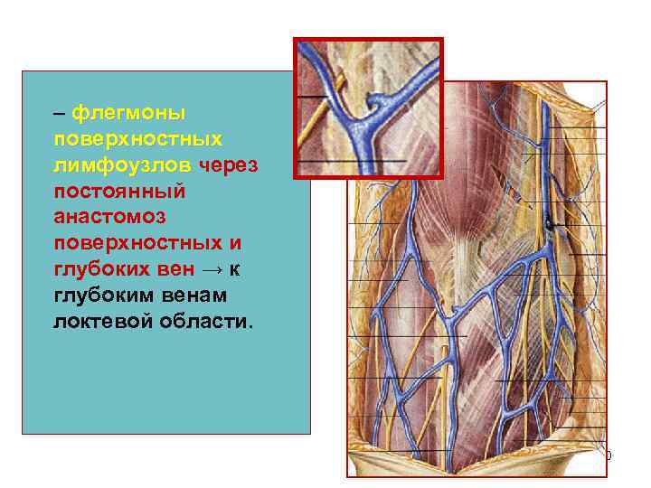 – флегмоны поверхностных лимфоузлов через постоянный анастомоз поверхностных и глубоких вен → к глубоким