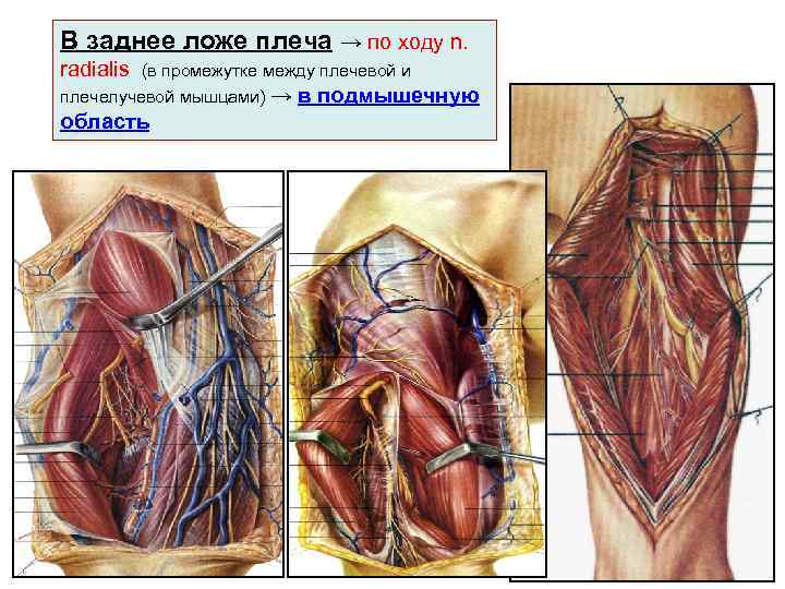 В заднее ложе плеча → по ходу n. radialis (в промежутке между плечевой и
