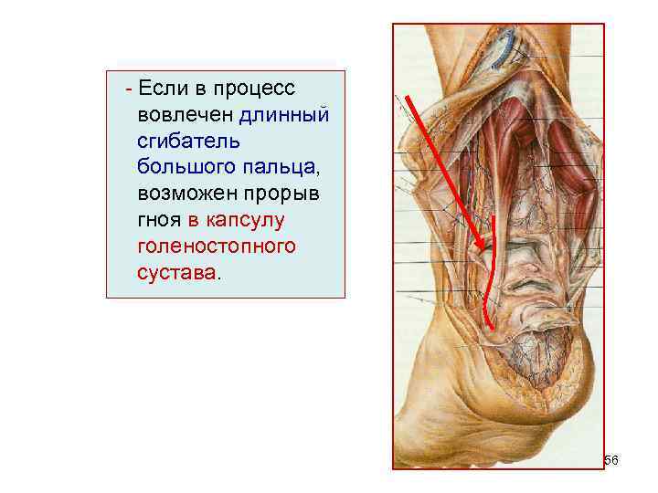 - Если в процесс вовлечен длинный сгибатель большого пальца, возможен прорыв гноя в капсулу
