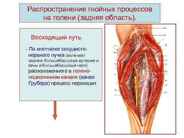 Распространение гнойных процессов на голени (задняя область). Восходящий путь. - По клетчатке сосудистонервного пучка