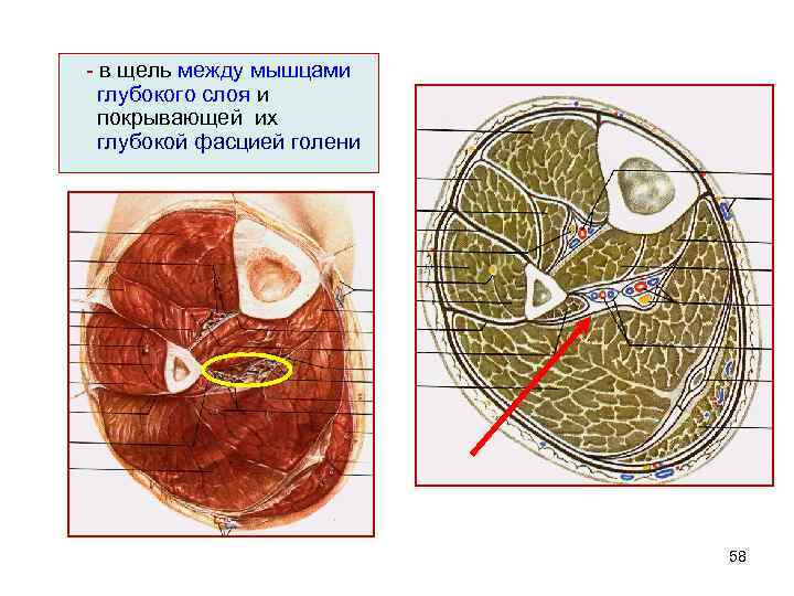 - в щель между мышцами глубокого слоя и покрывающей их глубокой фасцией голени 58