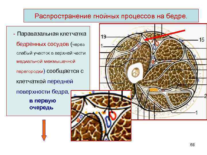 Распространение гнойных процессов на бедре. - Паравазальная клетчатка бедренных сосудов (через слабый участок в