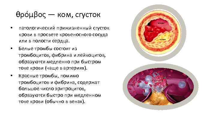 Тромбоз определение. Тромб состоит из тромбоцитов, фибрина и лейкоцитов:. (Фибрин кровяной сгусток.