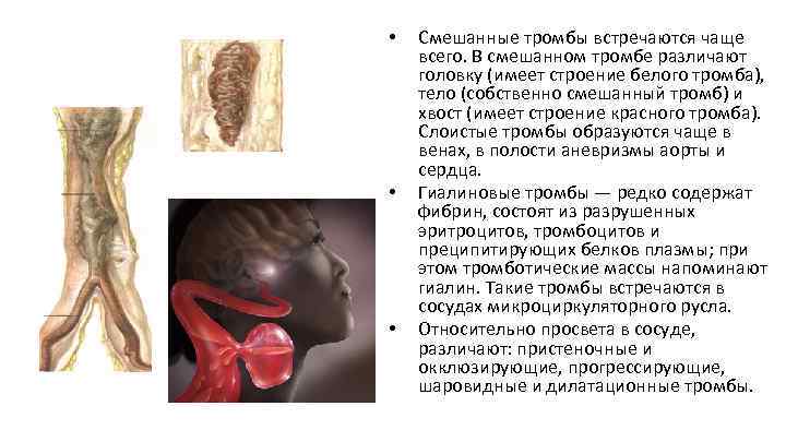  • • • Смешанные тромбы встречаются чаще всего. В смешанном тромбе различают головку