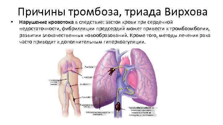  • Причины тромбоза, триада Вирхова Нарушение кровотока в следствие: застоя крови при сердечной