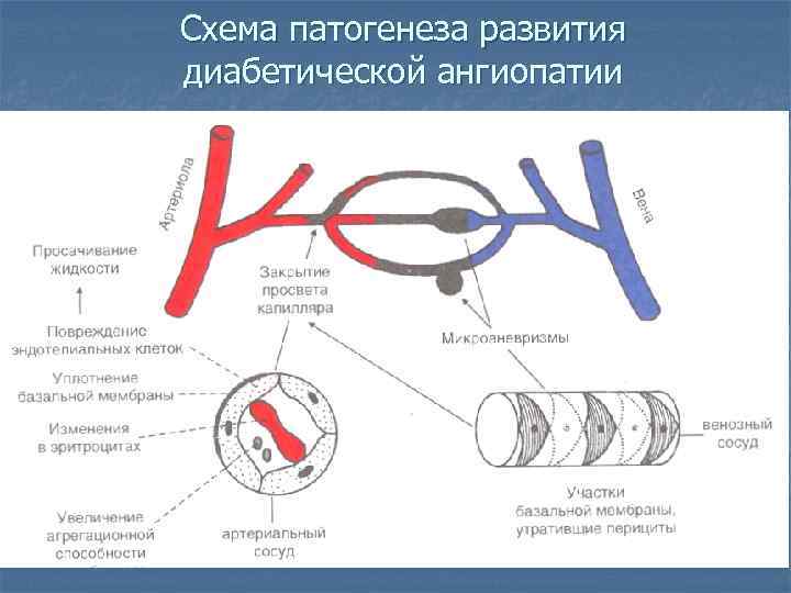 Схема патогенеза развития диабетической ангиопатии 