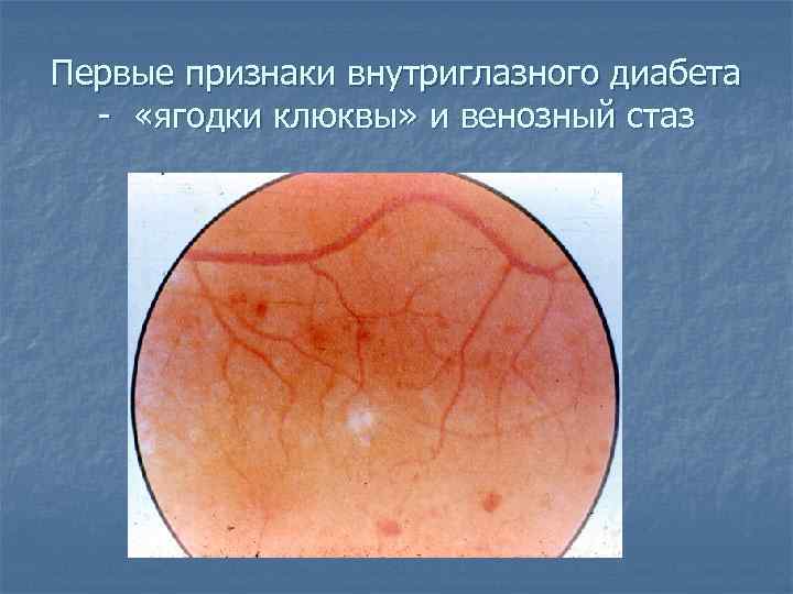 Первые признаки внутриглазного диабета - «ягодки клюквы» и венозный стаз 