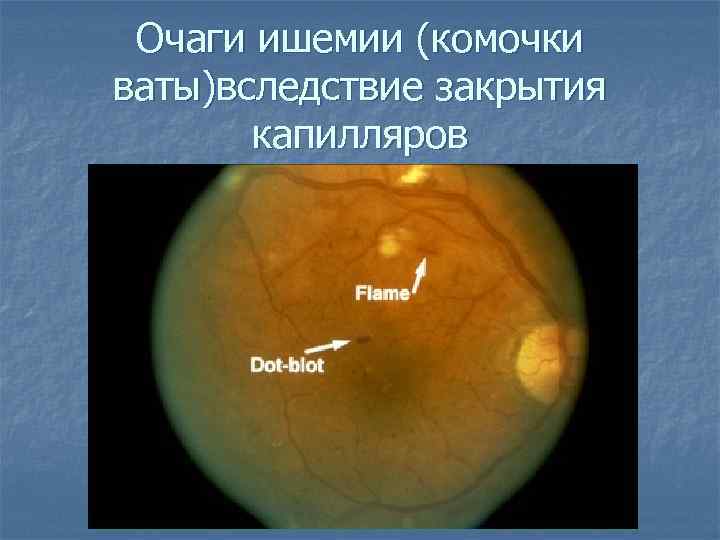 Очаги ишемии (комочки ваты)вследствие закрытия капилляров 