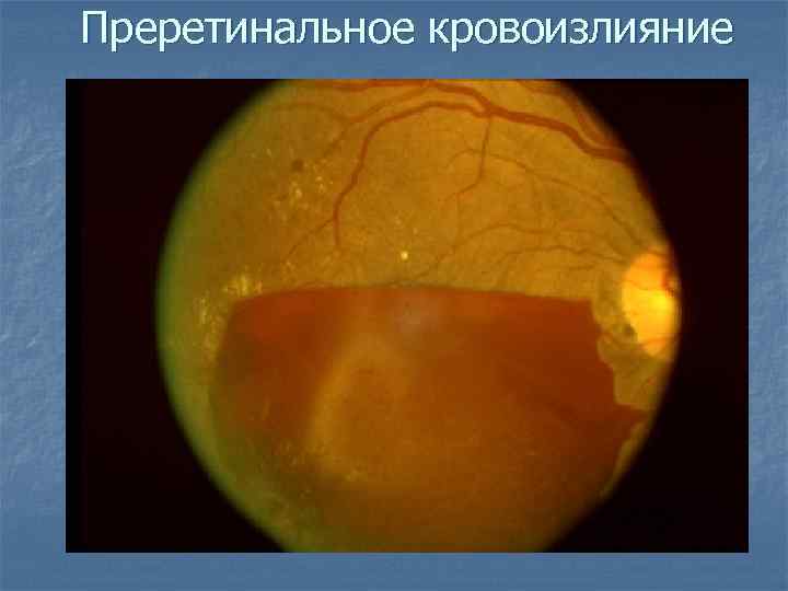 Преретинальное кровоизлияние 