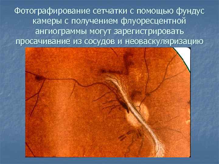 Фотографирование сетчатки с помощью фундус камеры с получением флуоресцентной ангиограммы могут зарегистрировать просачивание из