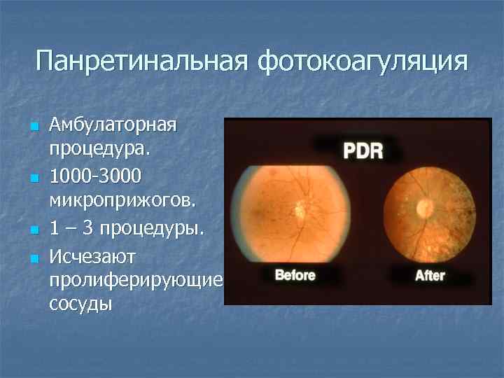 Панретинальная фотокоагуляция n n Амбулаторная процедура. 1000 -3000 микроприжогов. 1 – 3 процедуры. Исчезают