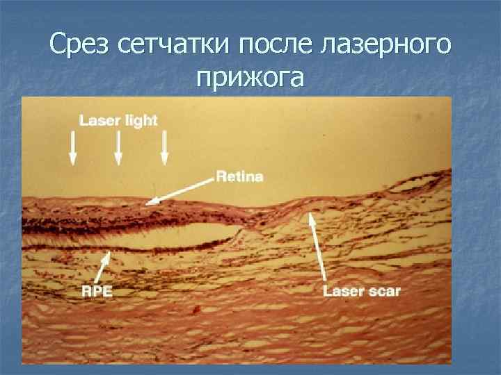 Срез сетчатки после лазерного прижога 