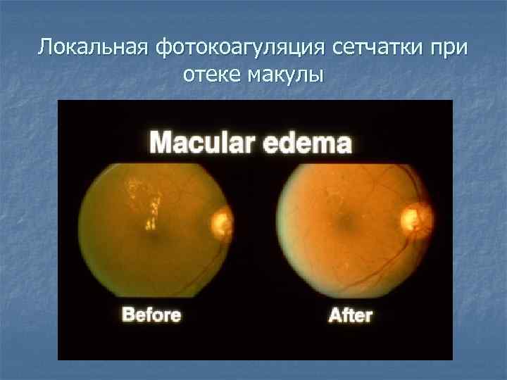 Локальная фотокоагуляция сетчатки при отеке макулы 