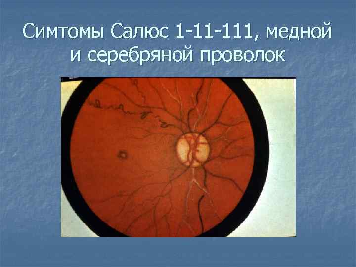 Симтомы Салюс 1 -11 -111, медной и серебряной проволок 