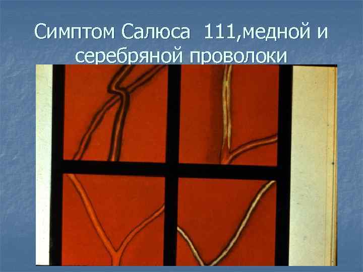 Симптом Салюса 111, медной и серебряной проволоки 