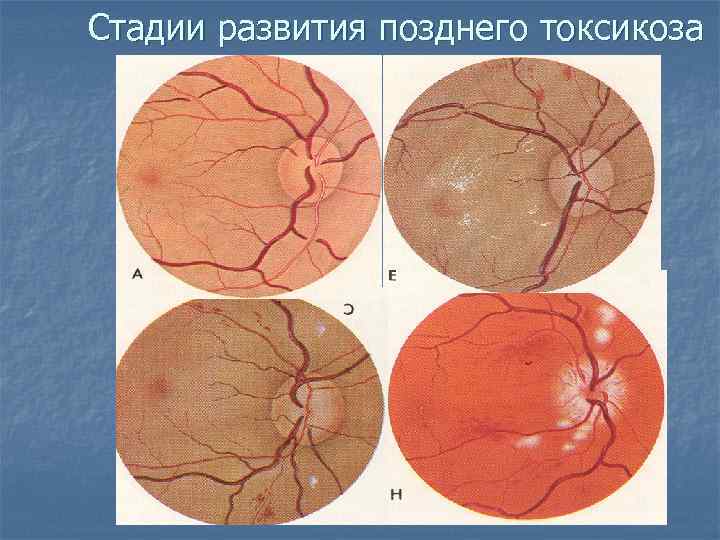 Стадии развития позднего токсикоза 