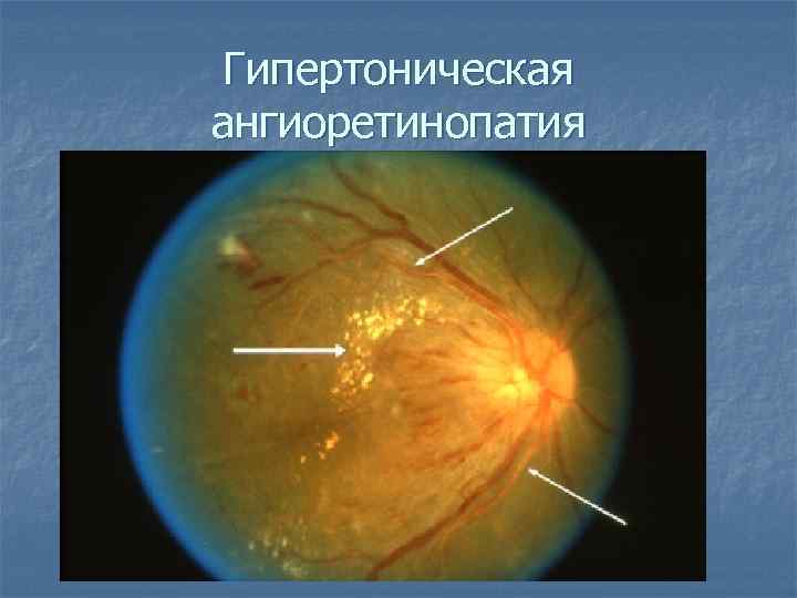 Гипертоническая ангиоретинопатия 