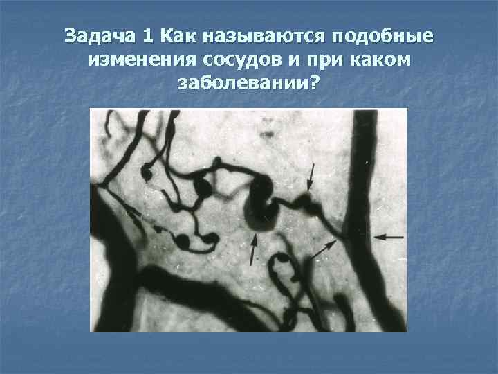 Задача 1 Как называются подобные изменения сосудов и при каком заболевании? 