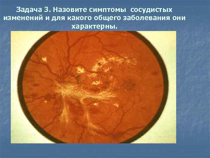 Задача 3. Назовите симптомы сосудистых изменений и для какого общего заболевания они характерны. 