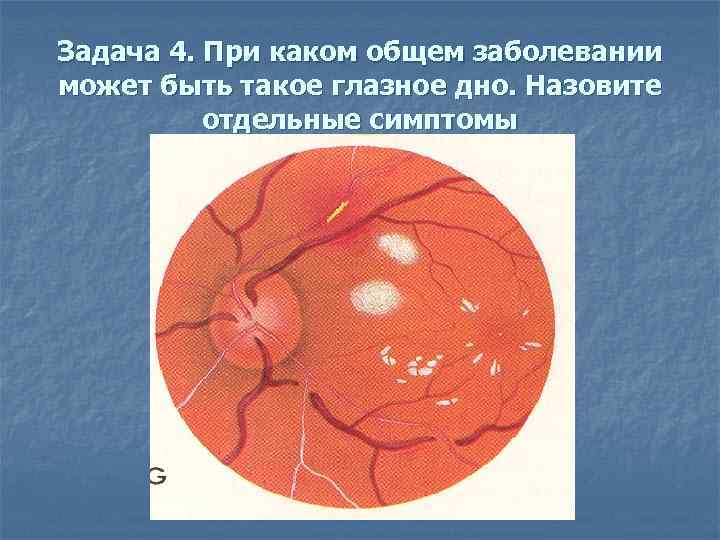 Задача 4. При каком общем заболевании может быть такое глазное дно. Назовите отдельные симптомы