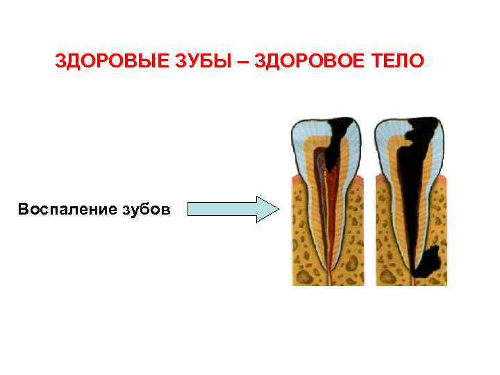 ЗДОРОВЫЕ ЗУБЫ – ЗДОРОВОЕ ТЕЛО Воспаление зубов 