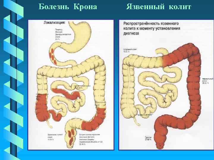 Заболевания кишечника симптомы. Язвенный колит кишечника распространенность. Болезнь крона локализация. Язвенный колит и болезнь крона. Болезнь крона кишечник.