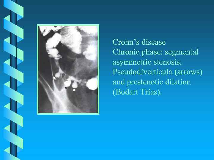 Crohn’s disease Chronic phase: segmental asymmetric stenosis. Pseudodiverticula (arrows) and prestenotic dilation (Bodart Trias).