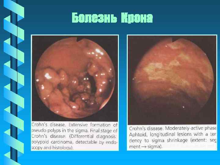 Болезнь Крона 