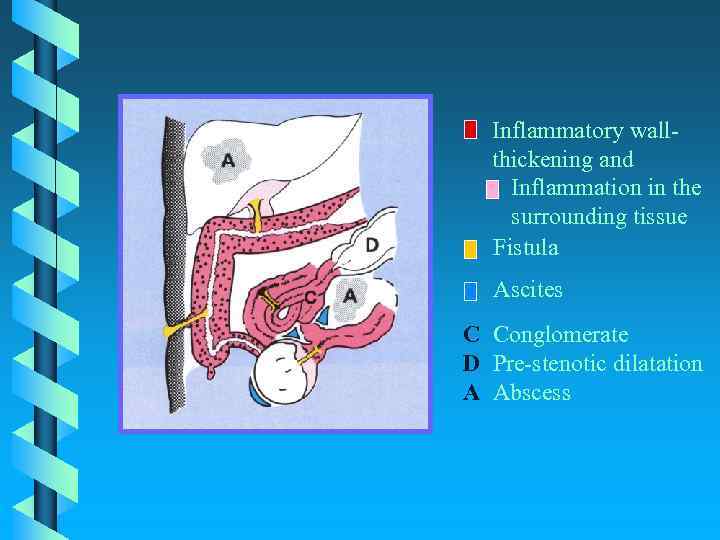 Inflammatory wallthickening and Inflammation in the surrounding tissue Fistula Ascites C Conglomerate D Pre-stenotic