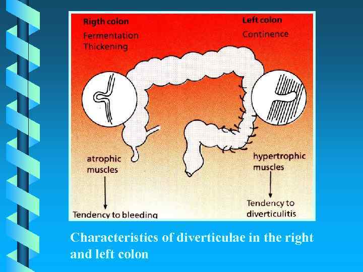 Characteristics of diverticulae in the right and left colon 