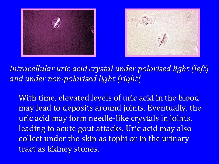 Intracellular uric acid crystal under polarised light (left) and under non-polarised light (right( With