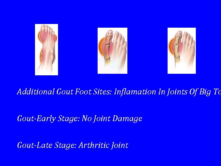Additional Gout Foot Sites: Inflamation In Joints Of Big To Gout-Early Stage: No Joint