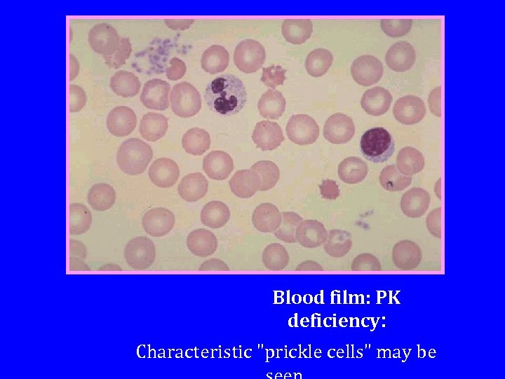 Blood film: PK deficiency: Characteristic "prickle cells" may be 