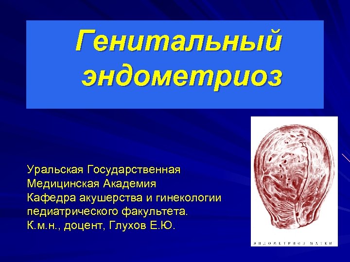 Генитальный эндометриоз Уральская Государственная Медицинская Академия Кафедра акушерства и гинекологии педиатрического факультета. К. м.