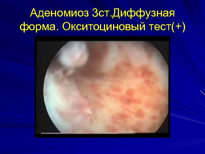 Аденомиоз 3 ст. Диффузная форма. Окситоциновый тест(+) 