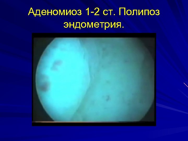 Аденомиоз 1 -2 ст. Полипоз эндометрия. 