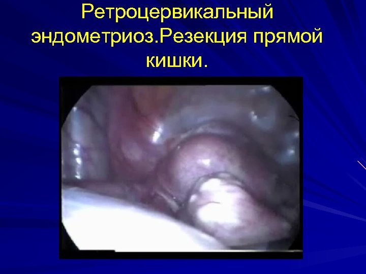 Ретроцервикальный эндометриоз. Резекция прямой кишки. 
