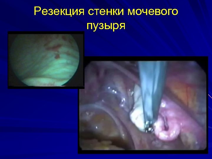 Резекция стенки мочевого пузыря 