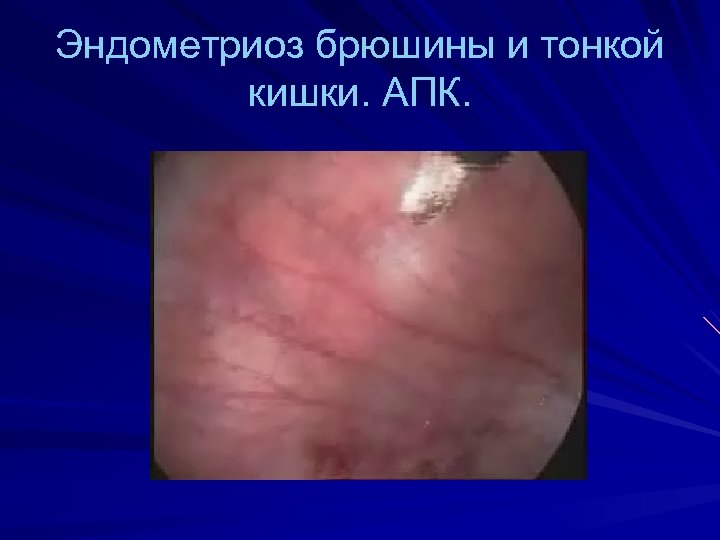 Эндометриоз брюшины и тонкой кишки. АПК. 