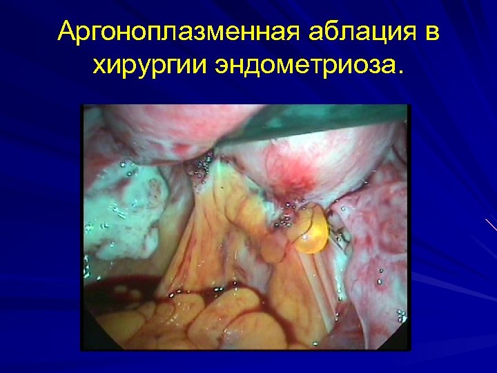Аргоноплазменная аблация в хирургии эндометриоза. 